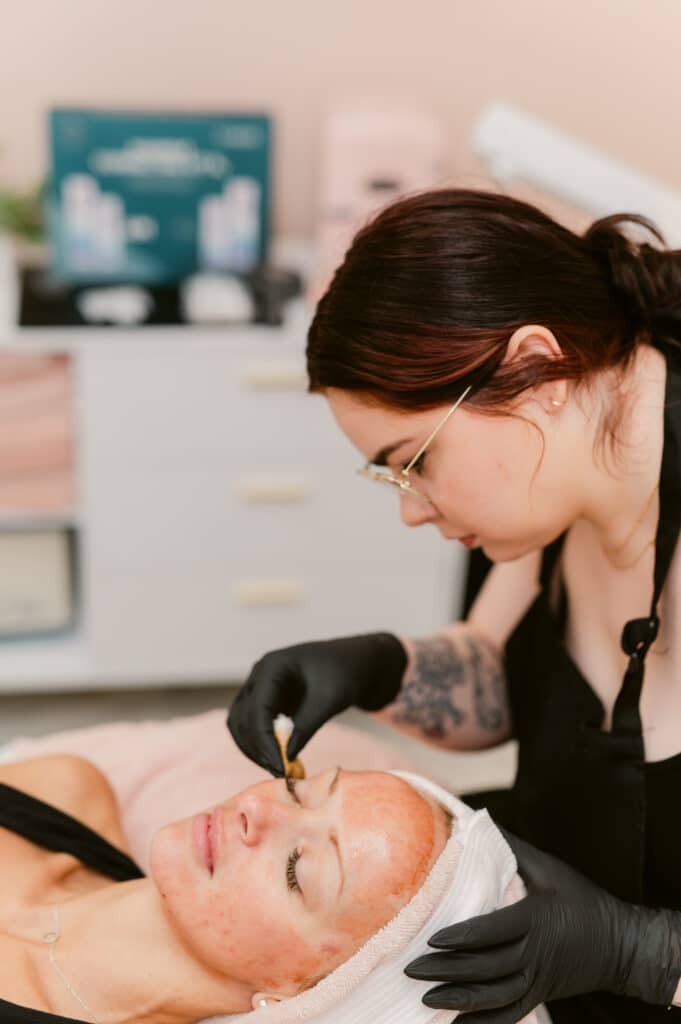 chemical peels Chemical Peels Richmond VA